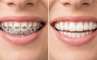 Braces vs Aligners – Which Is Better for You?