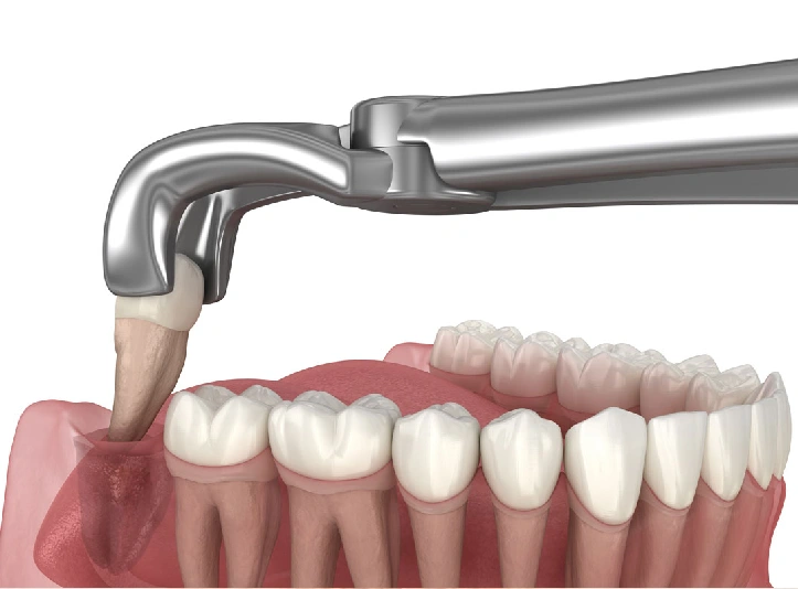 Wisdom Tooth Removal in Kharadi Wisdom Tooth Removal in Kharadi