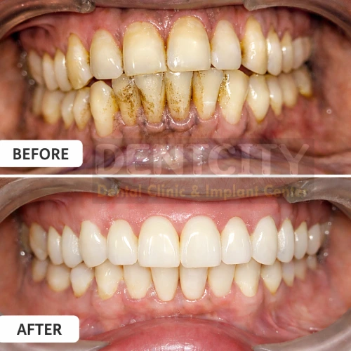 before and after Gum Disease Gum Disease