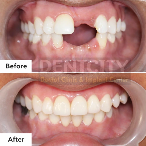 dental impalnt Dental impalnt results