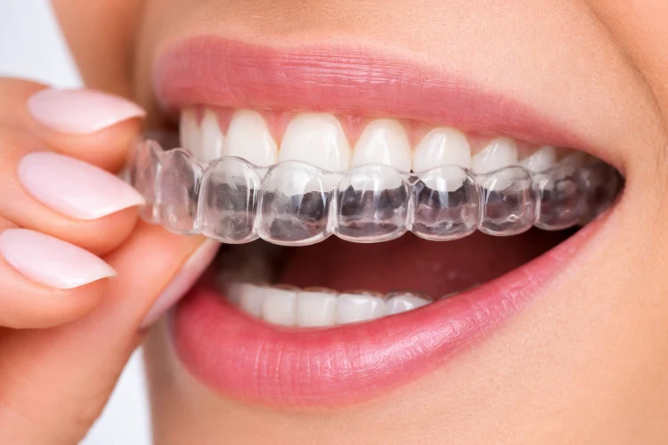 Teeth Aligners