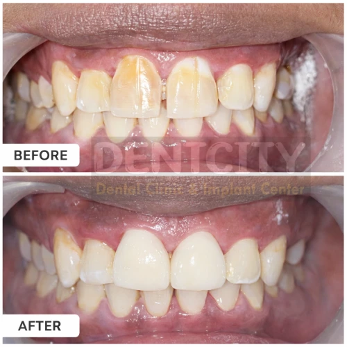 teeth whitening before and after Teeth whitening before and after