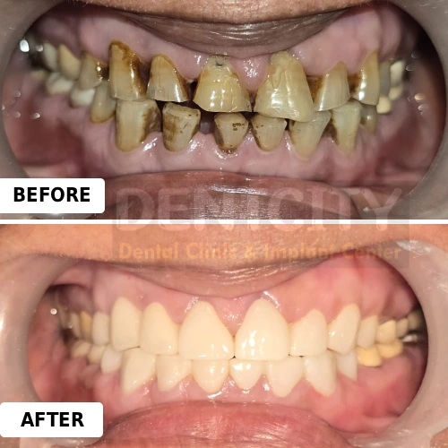 Smile designing ( Hollywood smile rejuvenation )